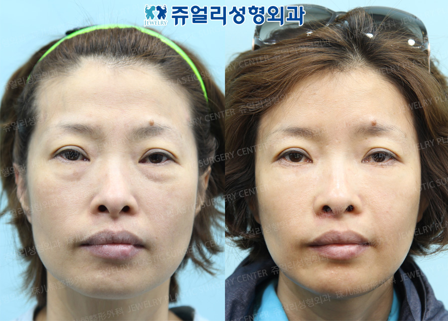 Fat Grafting + Fat-Repositioning Transconjunctival Blepharoplasty+Botox (Square Jaws, Glabella)