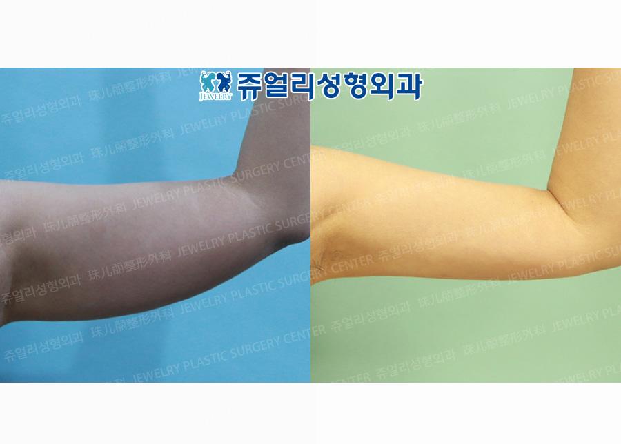 Arm Liposuction