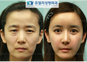 Eyes Surgery+Nose Surgery+Face Fat Grafting+Chin Liposuction
