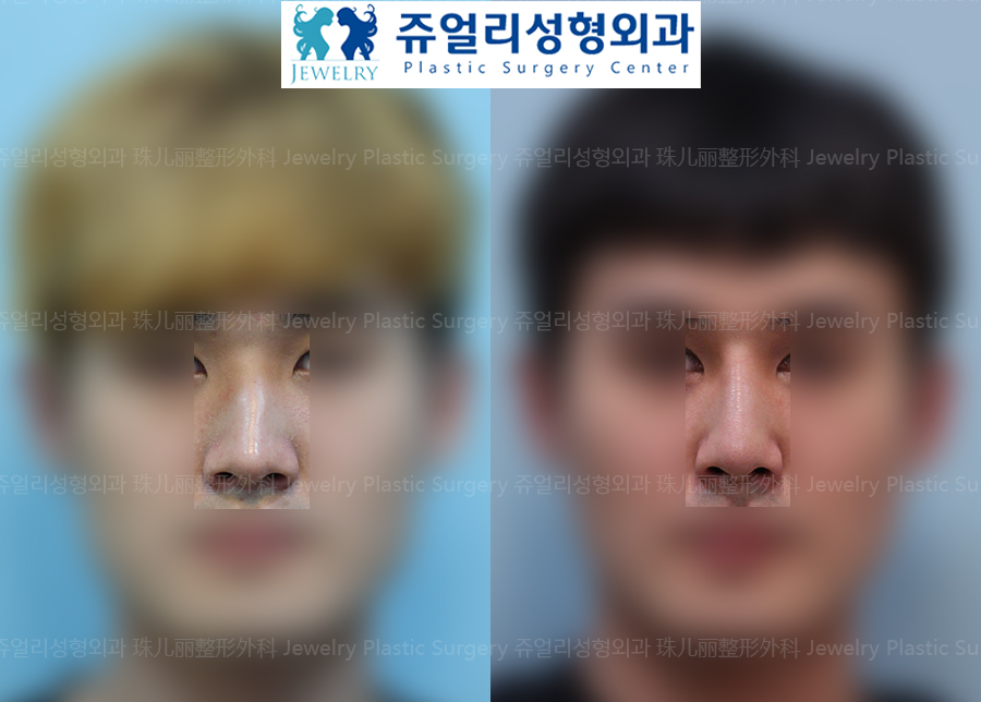 (Men) Nose Surgery - Bent Nose