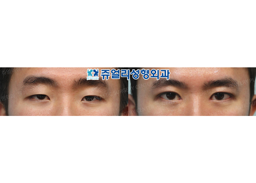 Ptosis + Epicanthoplasty