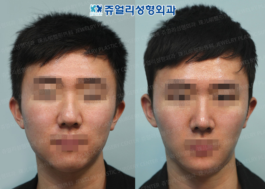 Men Nose Surgery + Chin Implant
