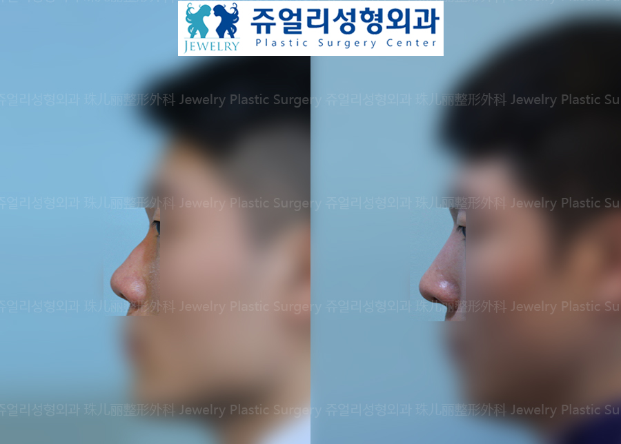 (Men) Nose Surgery - Wide Nose