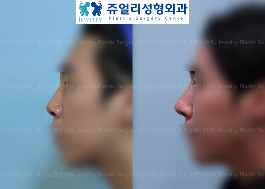 (Men) Nose Surgery - Hump, Upturned Nose