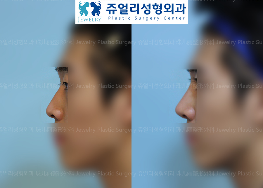 (Men) Nose Surgery