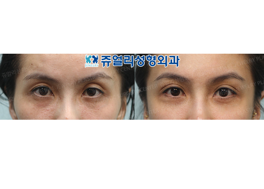 Eyelids Fat Grafting  + Double Eyelids (Non-Incision)