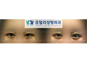 Lowering down the tail of the eyes + Dark Circles (Fat-Repositioning Transconjunctival)