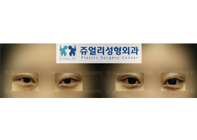 Lowering down the tail of the eyes + Dark Eyes (Fat-Repositioning Transconjunctival)