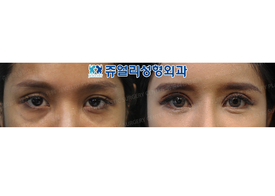 Ptosis Correction + Epicanthoplasty + Lateral Canthoplasty + Dark Circles