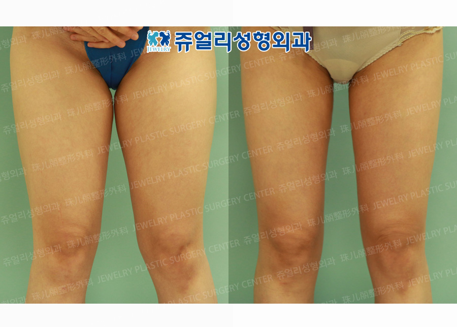 Thigh Liposuction