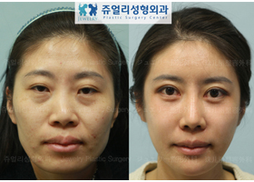 Eyes Surgery + Nose Surgery (Bent Nose) + Face Fat Grafting + 3DCT Cheekbone Reduction + V-Line Squrare Jaws Reduction