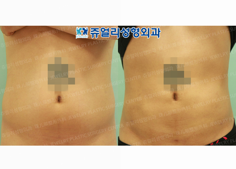 Abdominal, Flank, Back Side Liposuction