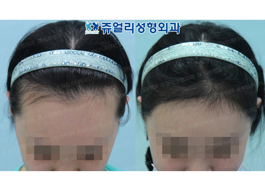 Hair Transplant