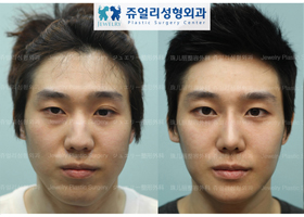 Total Image Surgery: Ptosis Correction+Dark Circle Removal+Nose Surgery+Front Chin Length Reduction, Non-asymmetrical correction & Advancement + Chin Botox