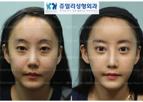 Total Image Surgery: Double Eyelids+Lower Lateral Canthoplasty+Dark Circle Removal+Nose Surgery+Fat Grafting+Cheek, Double Chin Liposuction, Accusculpt+Chin Botox