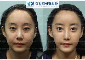 Total Image Surgery: Double Eyelids+Lower Lateral Canthoplasty+Dark Circle Removal+Nose Surgery+Fat Grafting+Cheek, Double Chin Liposuction, Accusculpt+Chin Botox