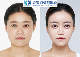Facial Contouring Surgery, Eyes Surgery, Nose Surgery, Fat Grafting
