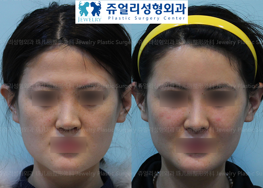Nose Surgery - Wide Nose (Removal of Columella)