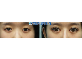 Double Eyelids Reoperation + Epicanthoplasty