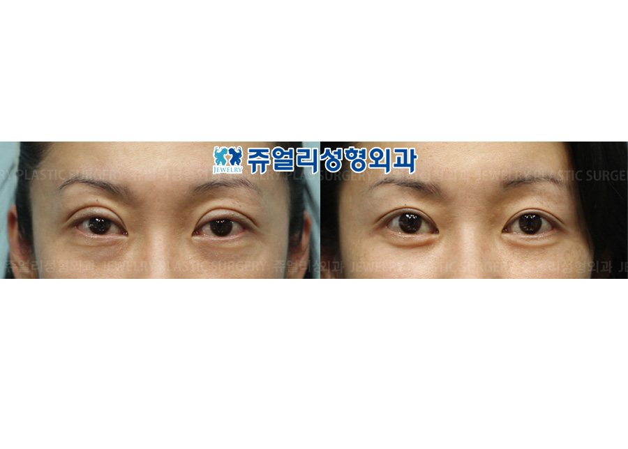 Double Eyelids Reoperation (Sausage Eyes)