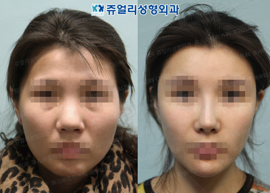 Cheekbone + Square Jaws + Front Chin Reduction