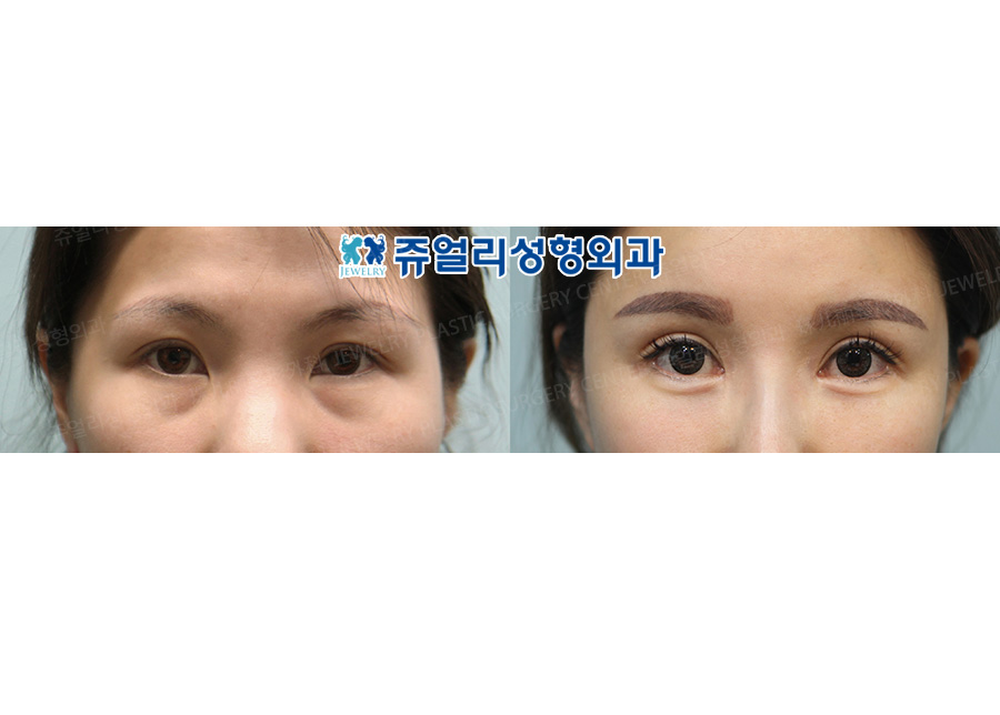 Ptosis + Epicanthoplasty + Lateral Canthoplasty + Lower Lateral Canthoplasty + Fat-Repositioning Transconjunctival (Loveband)