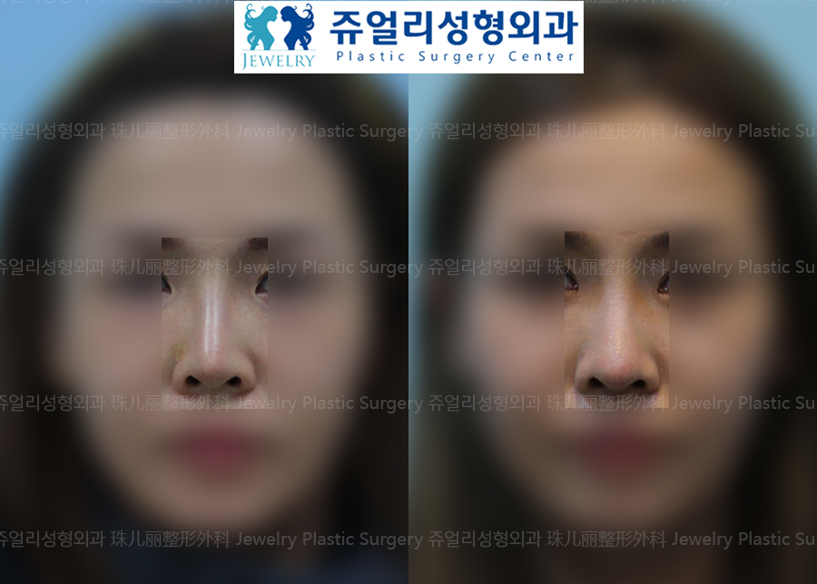 Nose Reoperation - Thin Skin (Temporal Fascia)