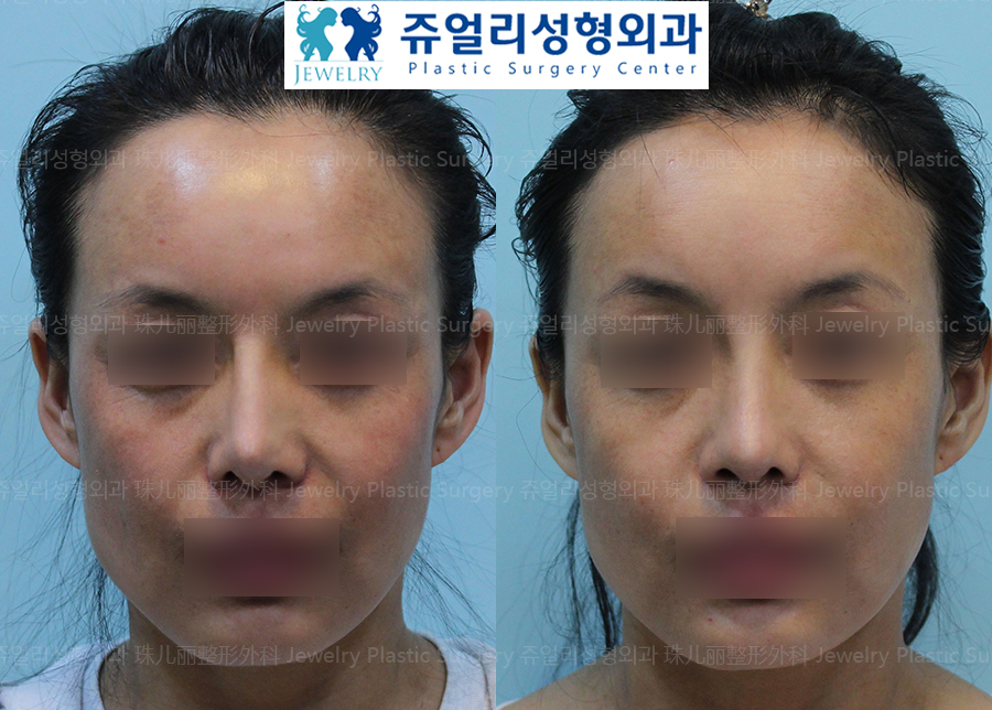 Nose Reoperation -  Thin Skin, Bent Nose (Dermis)