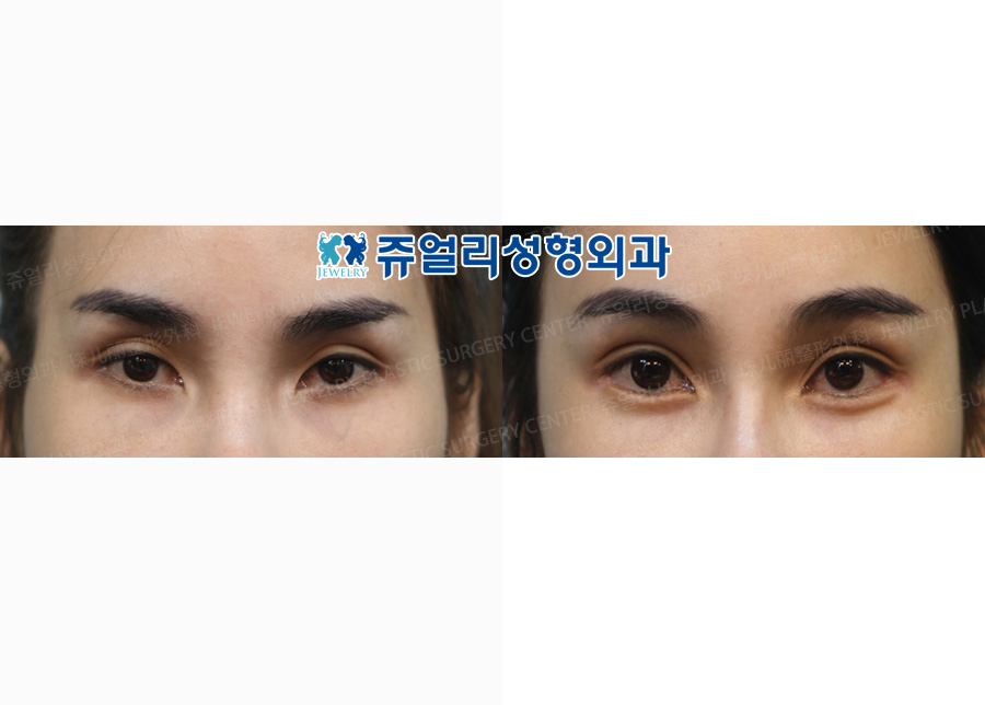 Ptosis + Lower Lateral Canthoplasty