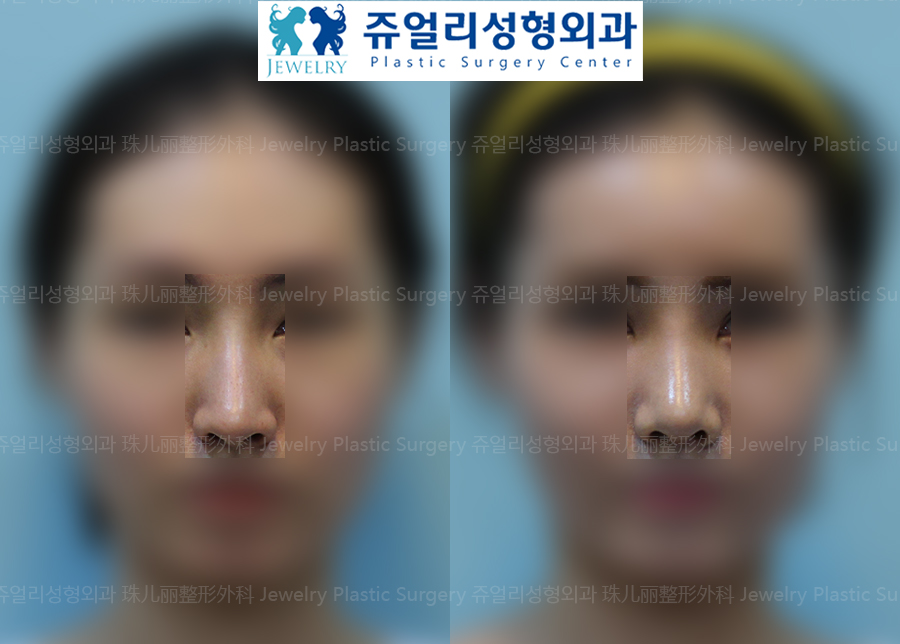 Nose Surgery - Autogenous Tissue Nose Surgery (Nasal Septum, Temporal Fascia)