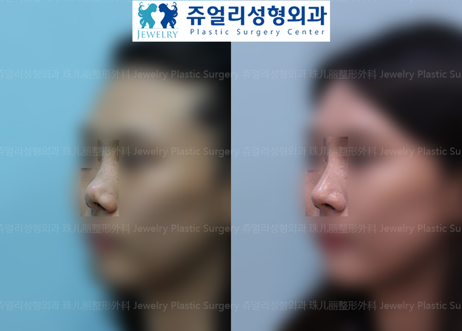 Nose Reoperation - Autogenous Tissue Nose Surgery (Nasal Septum, Autogenous Dermis)