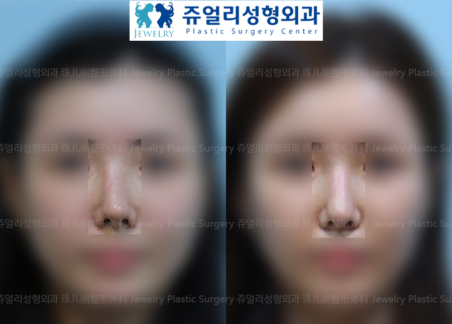 Nose Surgery- Autogenous Tissue Nose Surgery (Nasal Septum, Autogenous Dermis)