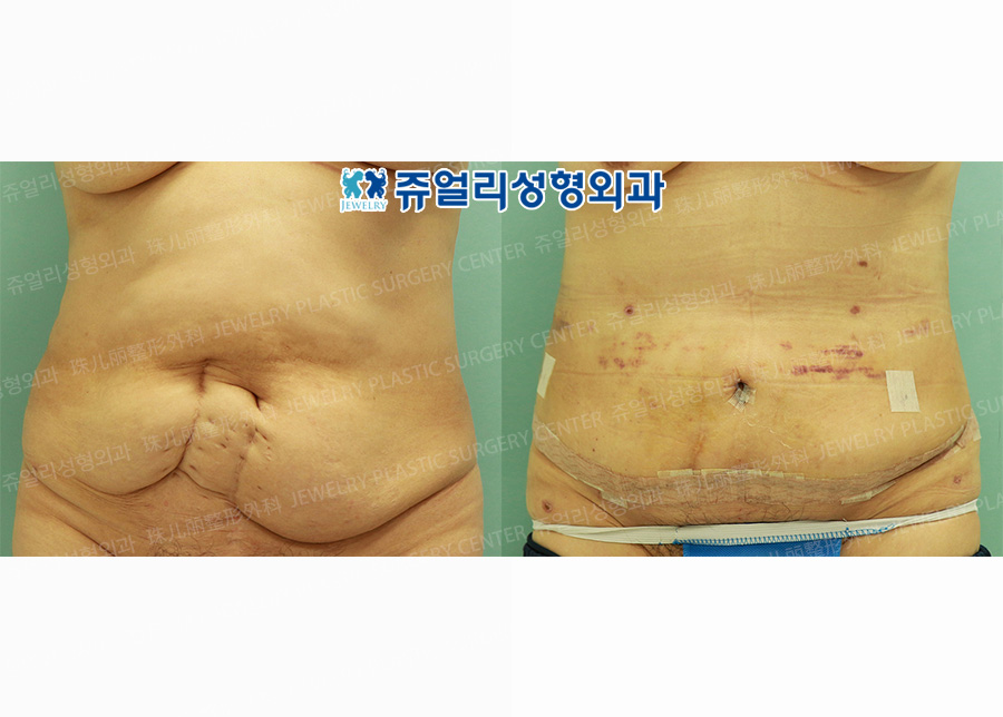 Abdominal Wall Surgery + Liposuction (Day 7)