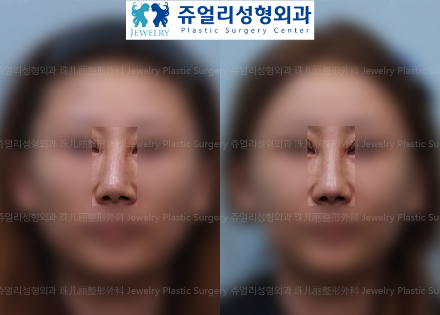 Nose Reoperation - Bent Nose Surgery