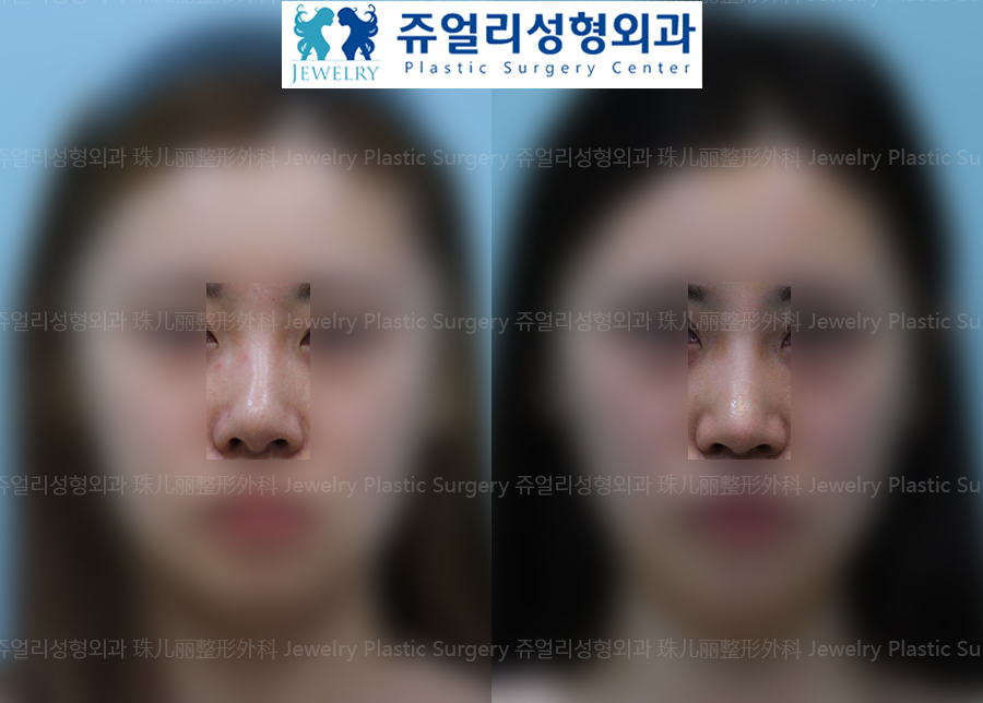 Nose Reoperation - Bent Nose Surgery