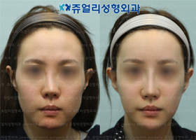 Cheekbone Reduction + Square Jaws Reduction