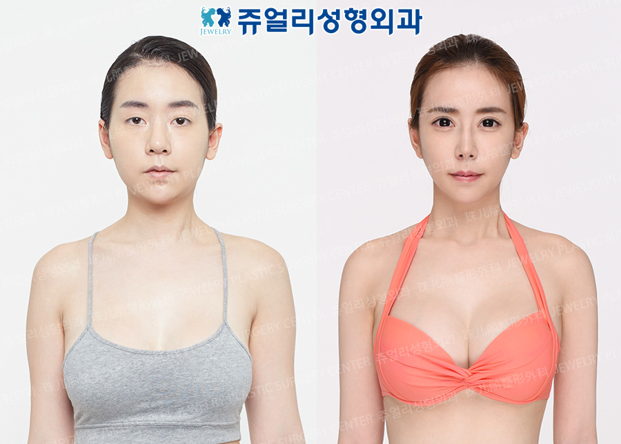 Breast Augmentation + Body Surgery