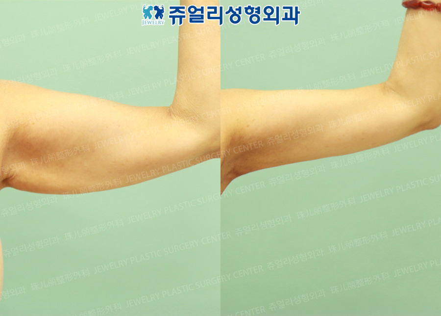 Arm Liposuction (+Face Excision)