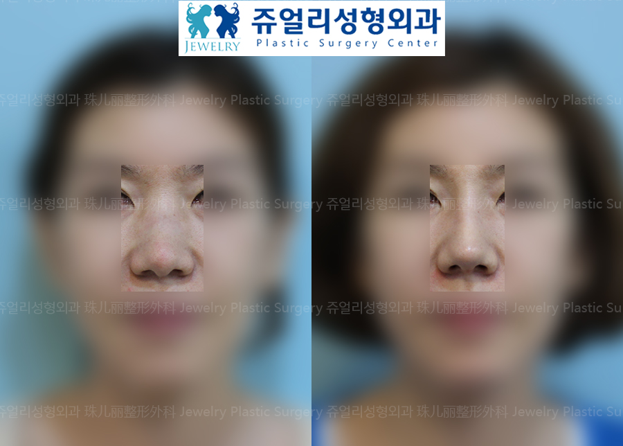 Nose Surgery-Osteotomy, Wide Nose Surgery