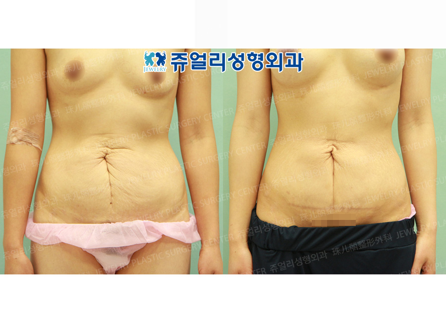 Abdominal Wall Surgery + Liposuction